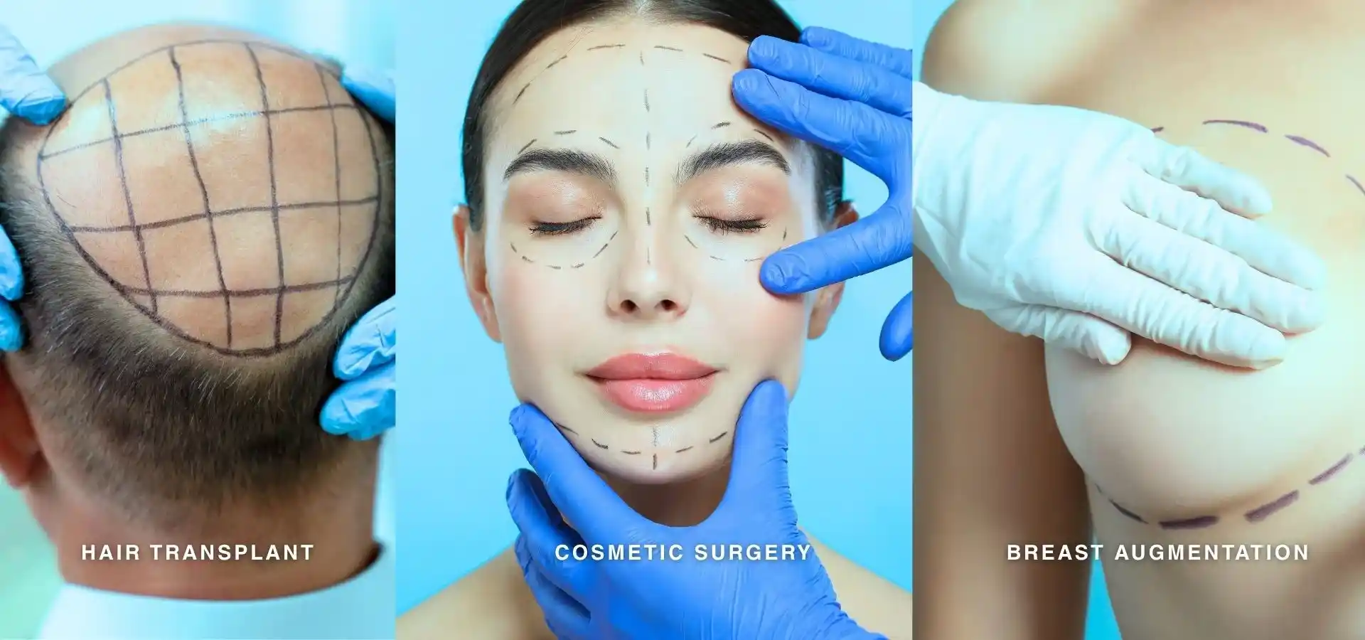 Dreiteilige Collage aus der ästhetischen Medizin mit Markierungen für eine Haartransplantation auf der Kopfhaut, kosmetische Gesichtsoperationen bei einer Frau sowie Markierungen für eine Brustvergrößerung mit der behandschuhten Hand eines Chirurgen.