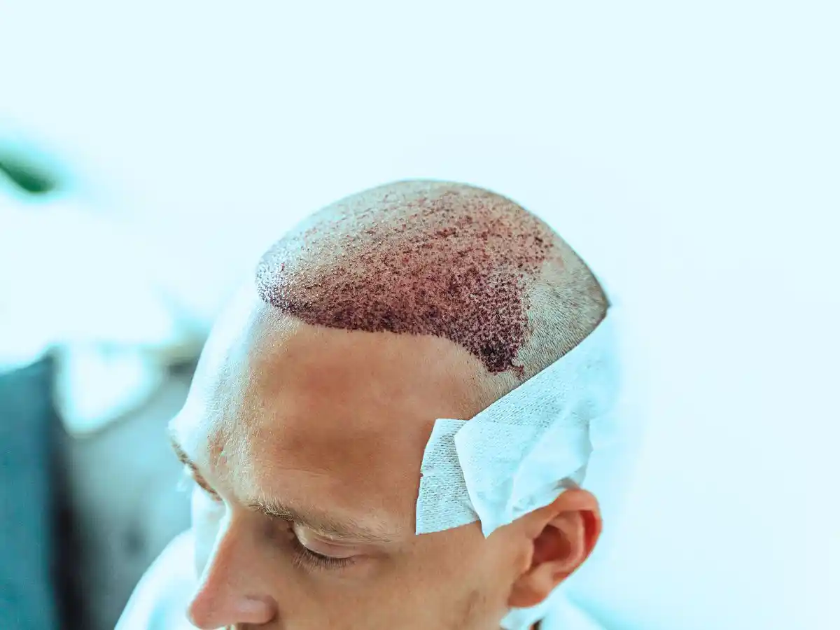 Hair transplant procedure showing a patient’s scalp with newly transplanted hair grafts