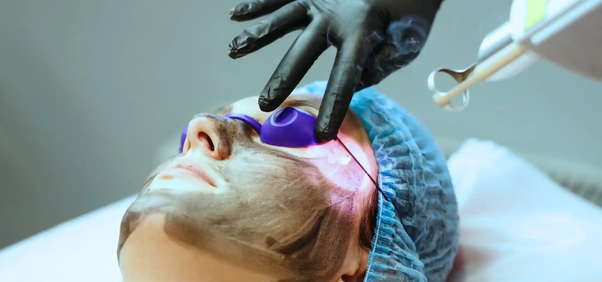 A woman undergoing a laser facial treatment while lying down, wearing protective purple eye goggles, with a professional wearing black gloves operating the laser device.