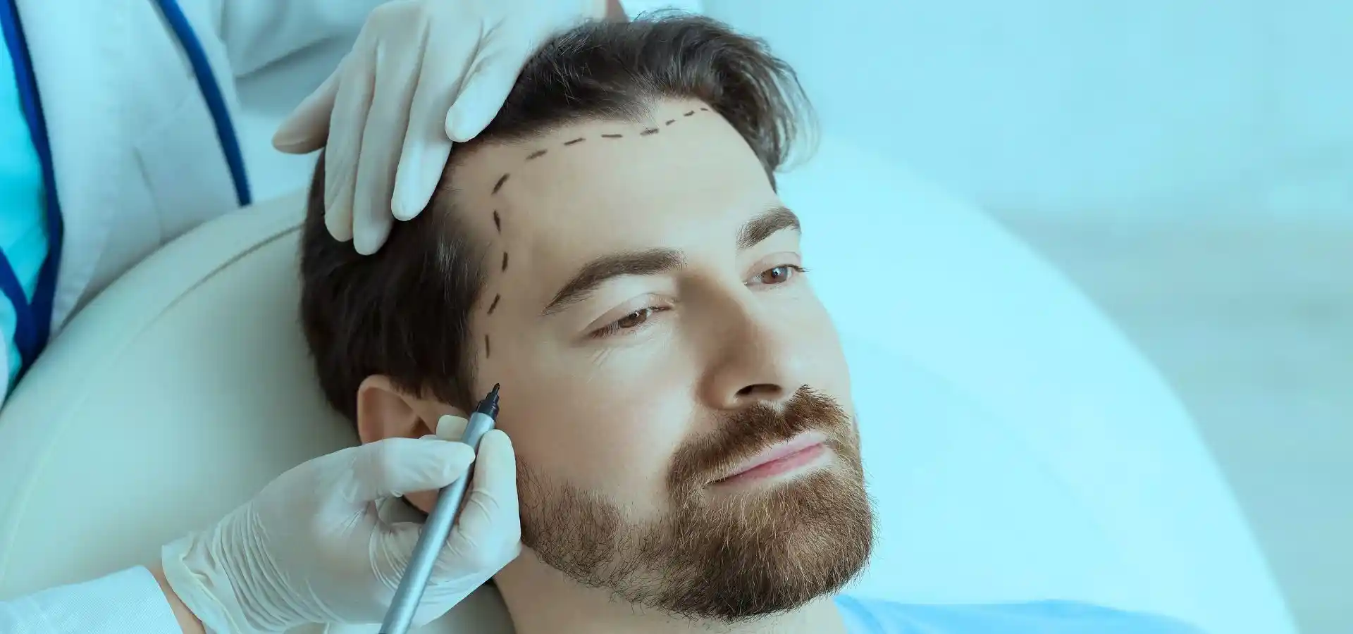 Male patient undergoing a hair transplant consultation, with a medical professional marking the hairline and treatment area on the scalp before the procedure.