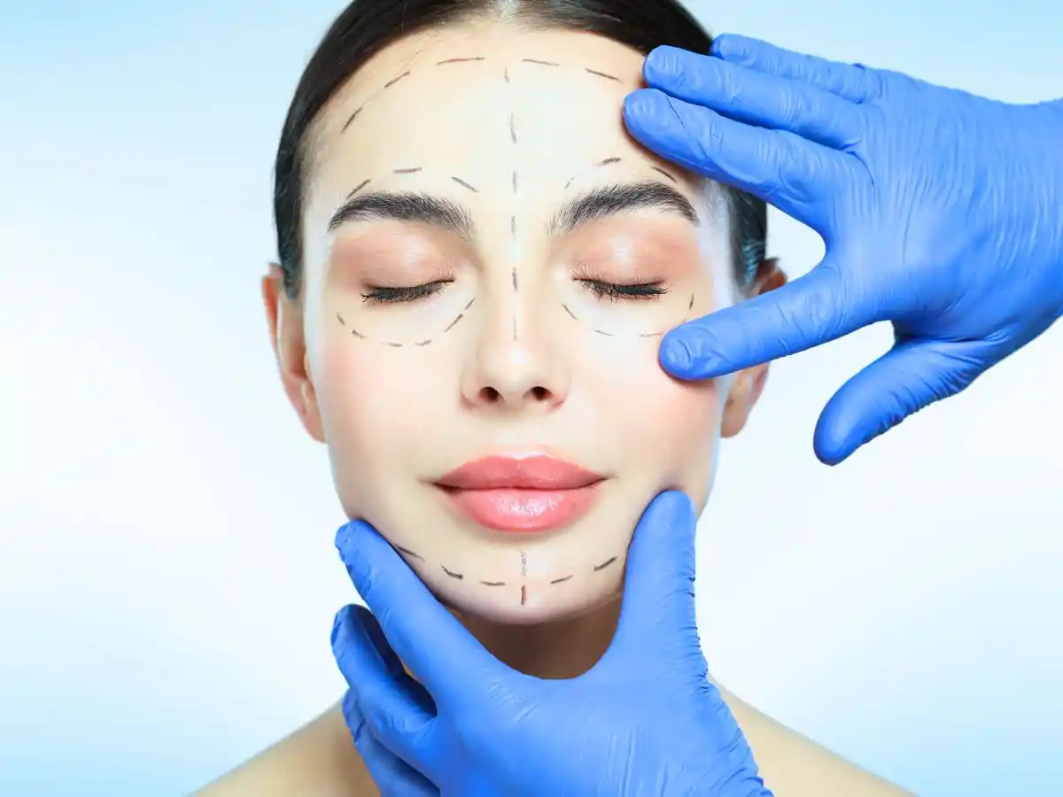 Woman with facial markings for a cosmetic or facial aesthetic procedure